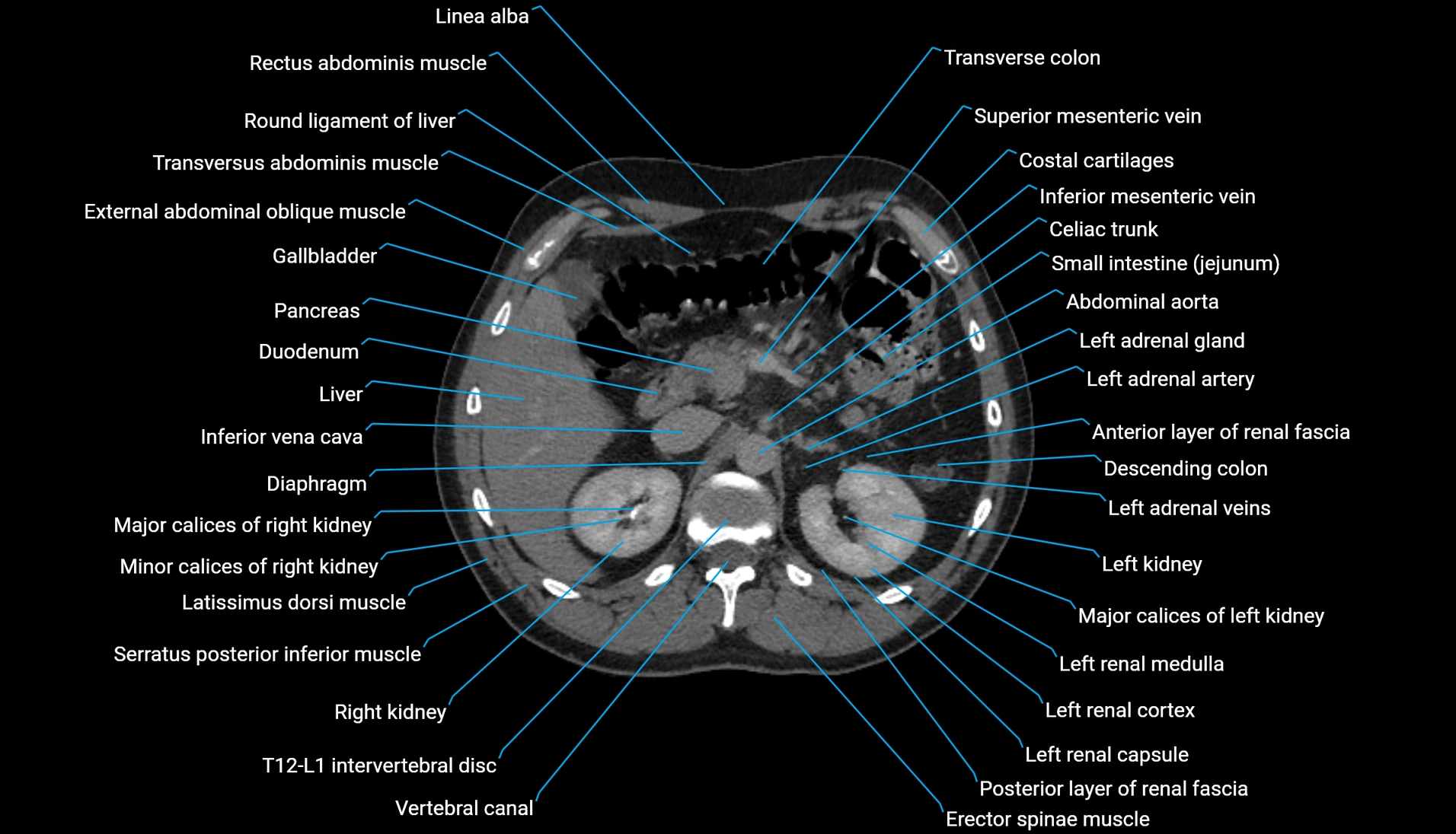 CT urogram axial cross sectional anatomy  labelled radiology image-00087.webp